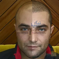 نمونه کار تیم کاشت موی رحیمی در تبریز - 8