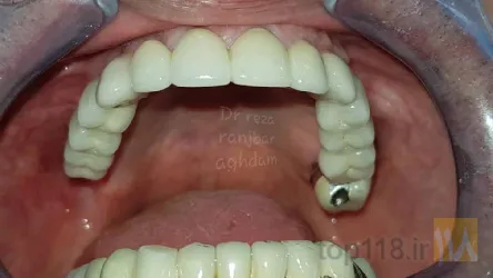 نمونه کار دکتر رضا رنجبر اقدم   ایمپلنت تمام فک- طرح لبخند متناسب با صورت- لمینیت-کامپوزیت در تبریز - 8