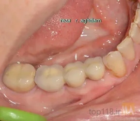 نمونه کار Tüm çənə implant-estetika در تبریز - 8