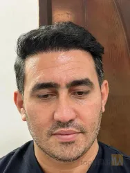 نمونه کار  کاشت مو ایمانی در تبریز - 7