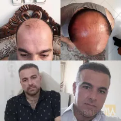 نمونه کار کاشت مو تخصصی در تبریز - 8